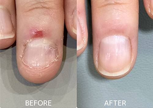 広島ネイルスクール｜アセトン不使用の完全オーガニック自爪育成ネイルケアLOHAS