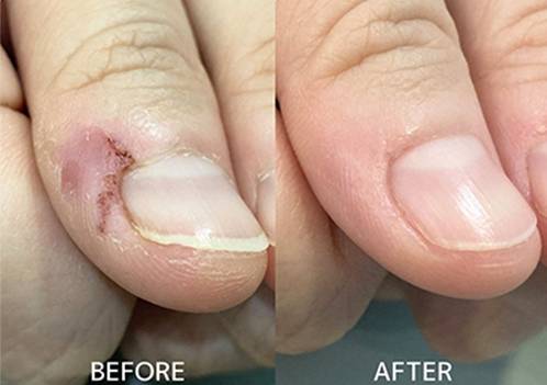 広島ネイルスクール｜アセトン不使用の完全オーガニック自爪育成ネイルケアLOHAS