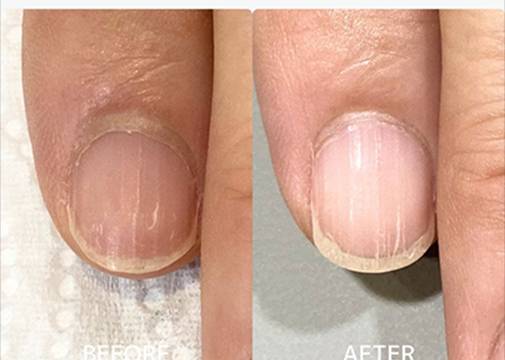 広島ネイルスクール｜アセトン不使用の完全オーガニック自爪育成ネイルケアLOHAS