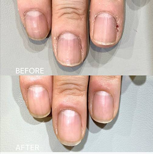 広島ネイルスクール｜アセトン不使用の完全オーガニック自爪育成ネイルケアLOHAS