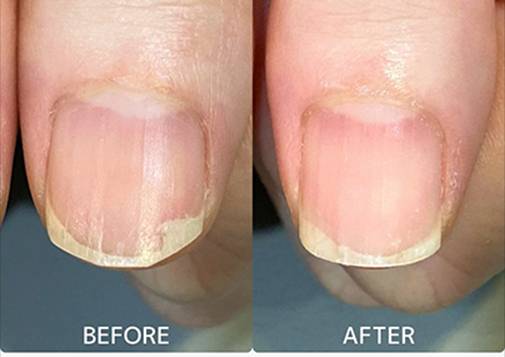 広島ネイルスクール｜アセトン不使用の完全オーガニック自爪育成ネイルケアLOHAS