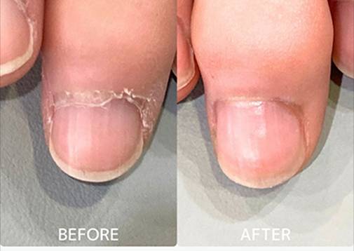 広島ネイルスクール｜アセトン不使用の完全オーガニック自爪育成ネイルケアLOHAS