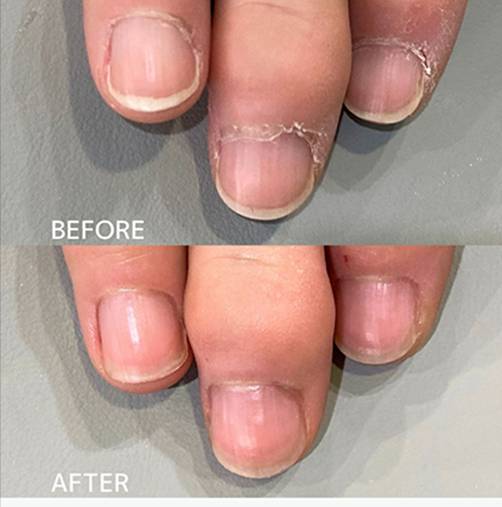 広島ネイルスクール｜アセトン不使用の完全オーガニック自爪育成ネイルケアLOHAS