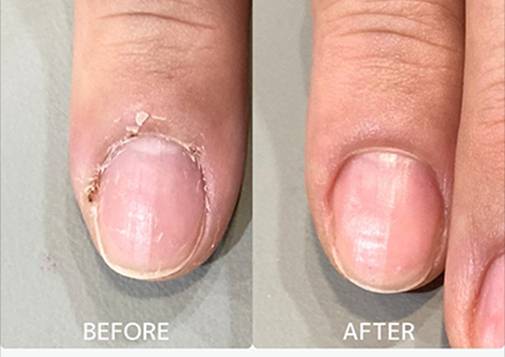 広島ネイルスクール｜アセトン不使用の完全オーガニック自爪育成ネイルケアLOHAS