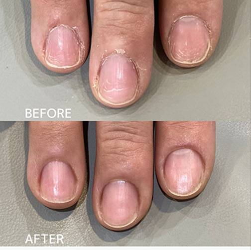 広島ネイルスクール｜アセトン不使用の完全オーガニック自爪育成ネイルケアLOHAS