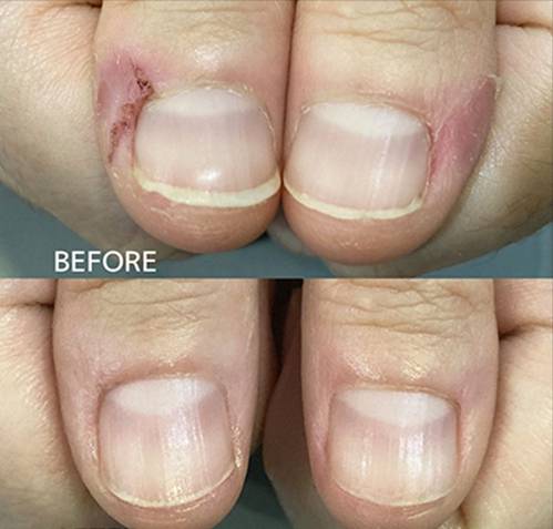 広島ネイルスクール｜アセトン不使用の完全オーガニック自爪育成ネイルケアLOHAS