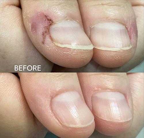 広島ネイルスクール｜アセトン不使用の完全オーガニック自爪育成ネイルケアLOHAS