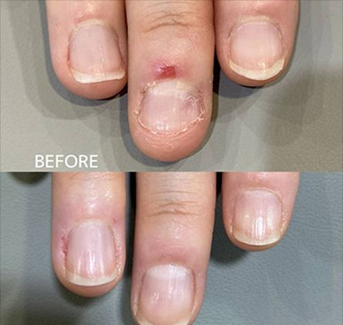 広島ネイルスクール｜アセトン不使用の完全オーガニック自爪育成ネイルケアLOHAS