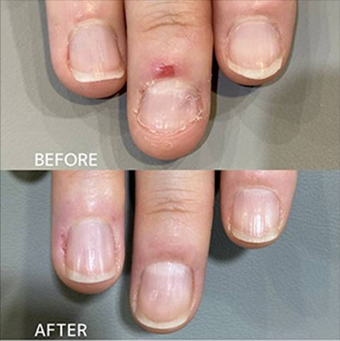 広島ネイルスクール｜アセトン不使用の完全オーガニック自爪育成ネイルケアLOHAS