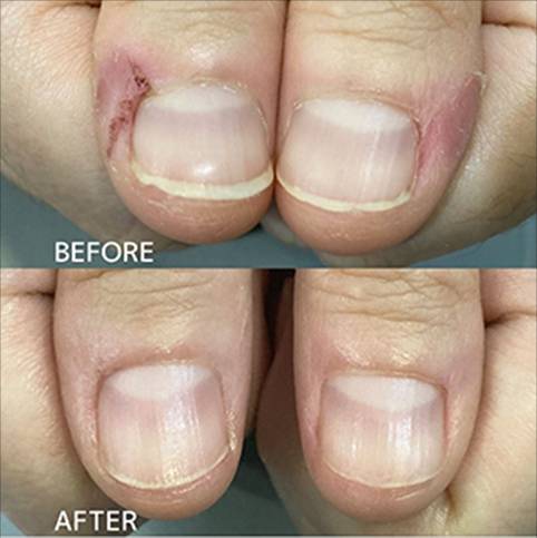 広島ネイルスクール｜アセトン不使用の完全オーガニック自爪育成ネイルケアLOHAS