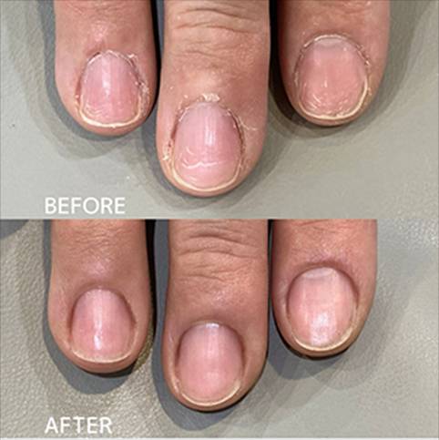 広島ネイルスクール｜アセトン不使用の完全オーガニック自爪育成ネイルケアLOHAS